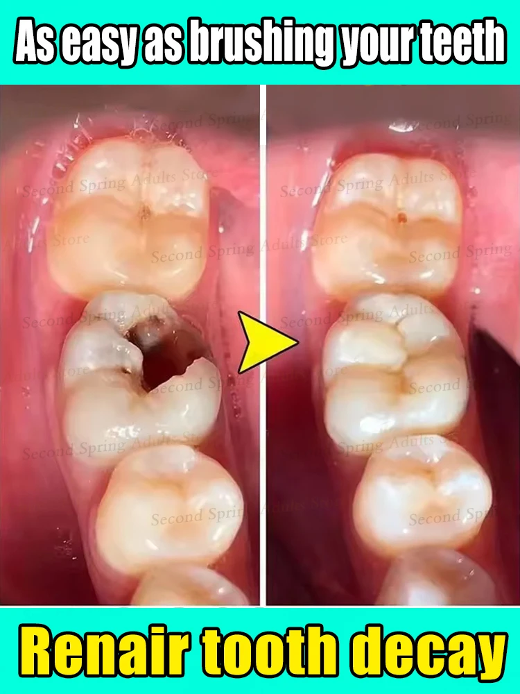 2025 Bestseller Tooth Mousse repair tooth decay removal Unisex