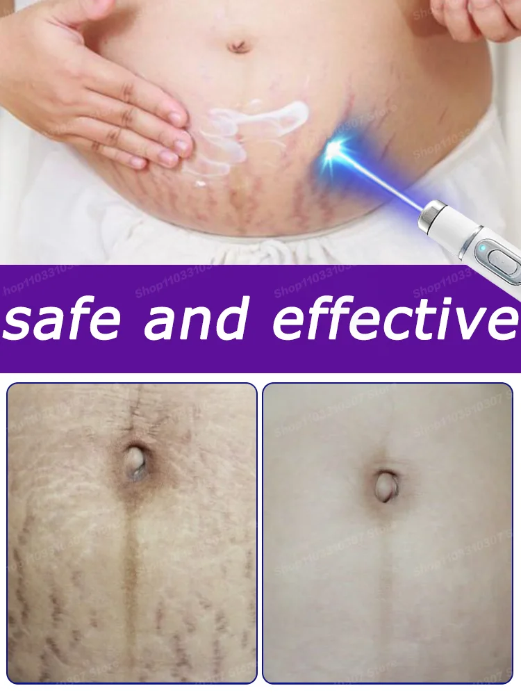 Improve Red White Old Stretch Marks