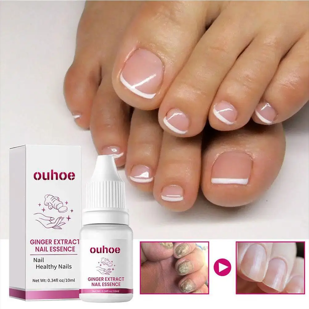 OUHOE 10ml Ginger Nail Essence Nourishing Rough Nails Anti Paronychia Nail Fungal Nail Treatment Essence Hand Foot Care