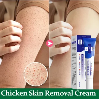 Curing Keratosis Pilaris Kip Follikel Huid Reparatie Crème Lichaam Donkere Vlek Verwijderen Witter Glad Hydrateren Huidverzorging Bodylotion