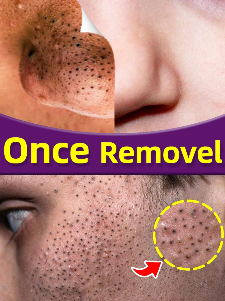 Blackhead Remover Mask Blackheads And Pimples Removing Cream Black Dots Clean Tool Tightening Repairing Facial Pore