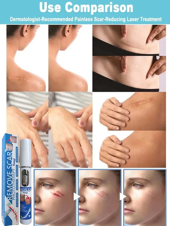 Blue Light Portable Laser Scar Remoção, Scientific Medical Potent, Cuidados com o corpo, Ferramentas de cuidados com a pele