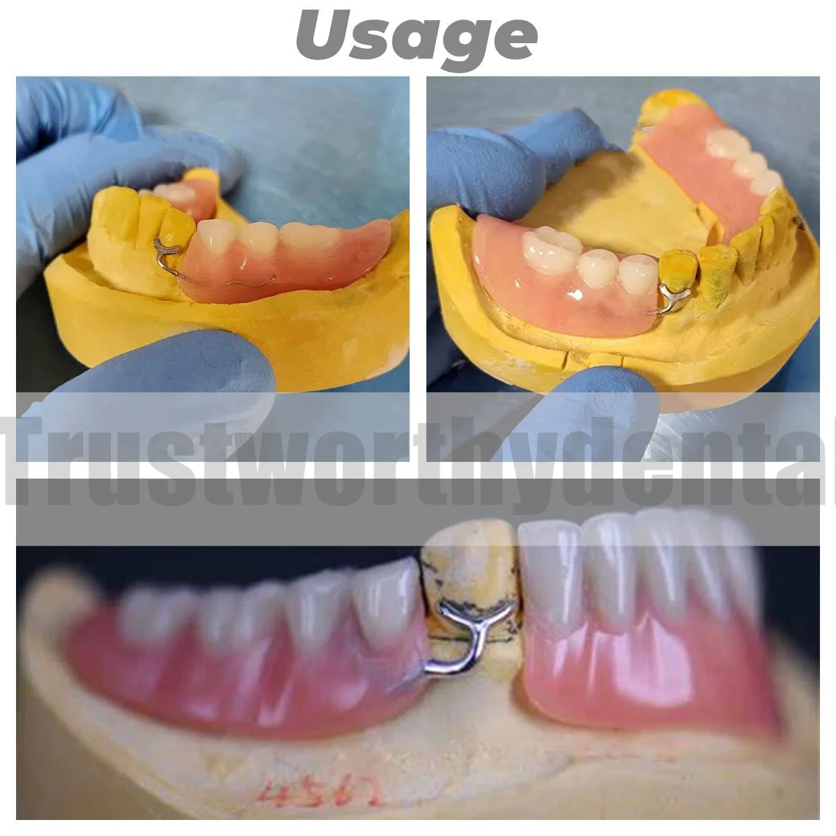 1.0mm Dental J Clasp Ball Retainer Roach Orthodontic Oblique Bar Y-Type Denture ScheuTeeth Position Hold