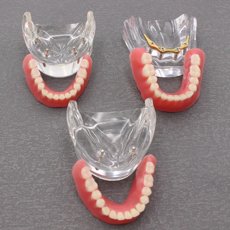 Dental Teeth Model With Implants Overdenture Superior Demo Model For Student Dentist patient communication model