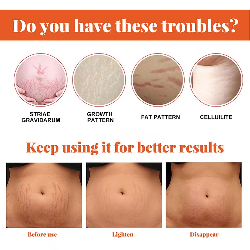 Stretch Marks Remover น้ํามันหอมระเหยการตั้งครรภ์คลอดบุตรใหม่เก่า Stretch Mark Removal Serum เพิ่มความยืดหยุ่นของผิว 20ml