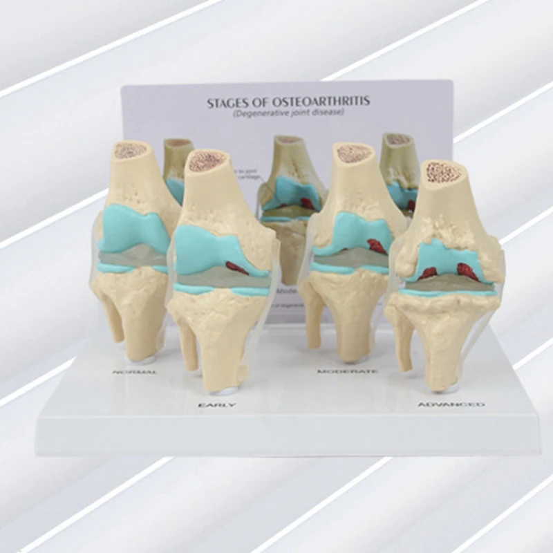 Knee Kit Osteoarthritis Anatomy Model With Educational Key Card 4 Stage Knee Model Orthopedic Teaching Aids