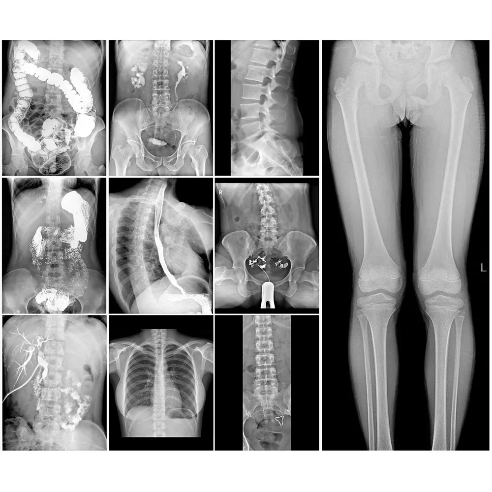 High Frequency X-ray Radiography and Digital Fluoroscopy System 650mA X ray Machine Price