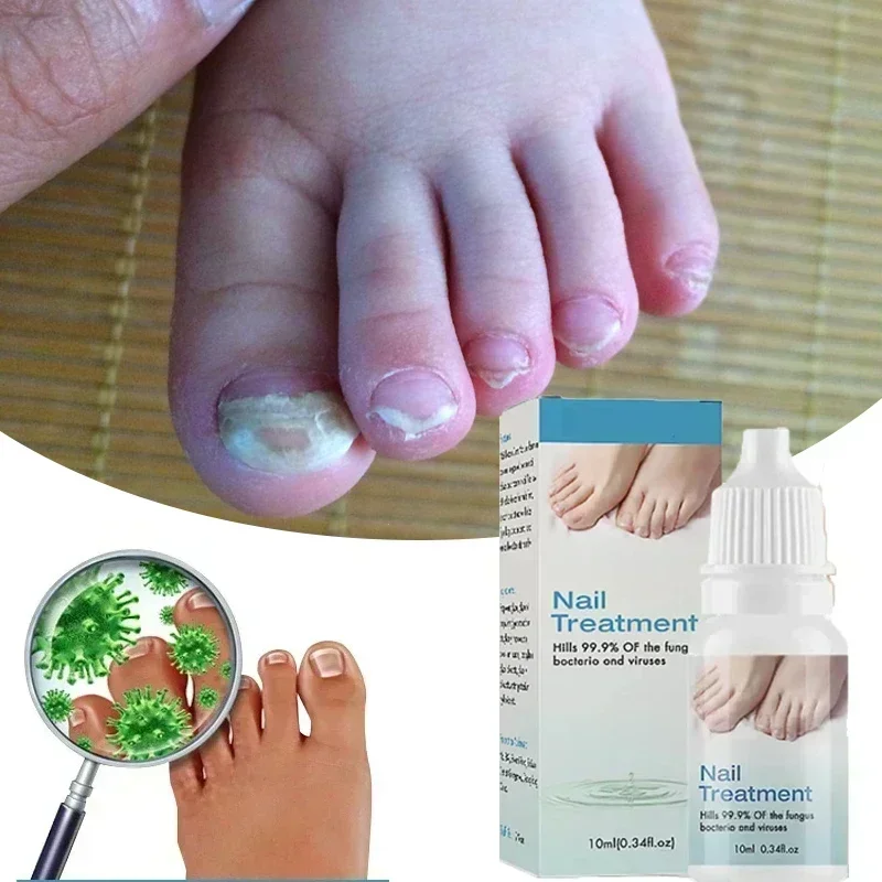 

10ml Onychomycosis Reparatie Serumzalf Onychomycosis Paronychia Zorgcrème Nagel Teennagel Voetverzorging Reparatie