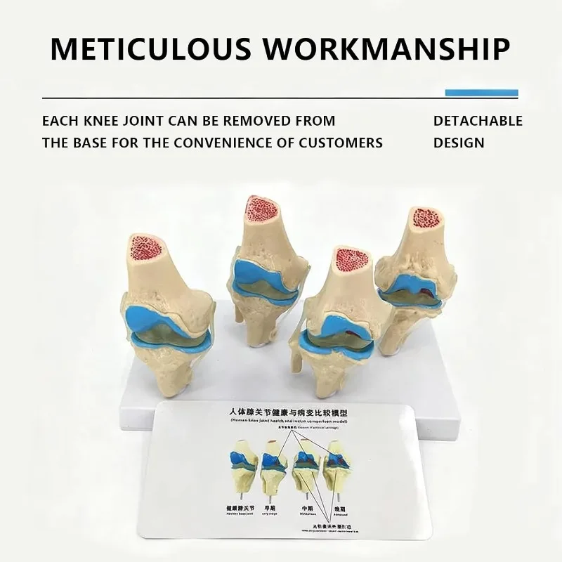 4-stage Knee Joint Model Plastic Bone Pathology Knee Anatomical Model PVC Bone Medical Skeleton Anatomy Teaching Model