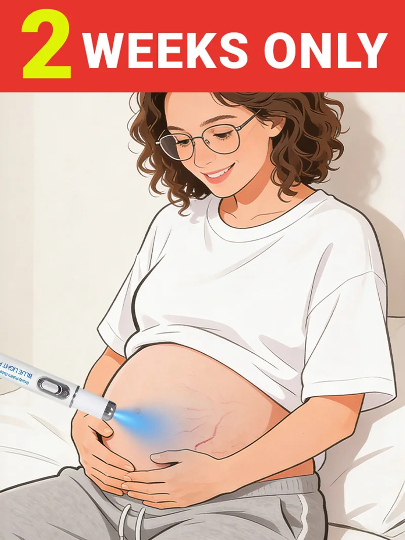 قلم الضوء الأزرق الجديد لعام 2026 لحل علامات تمدد الجسم وأدوات العناية بالبشرة أثناء الحمل