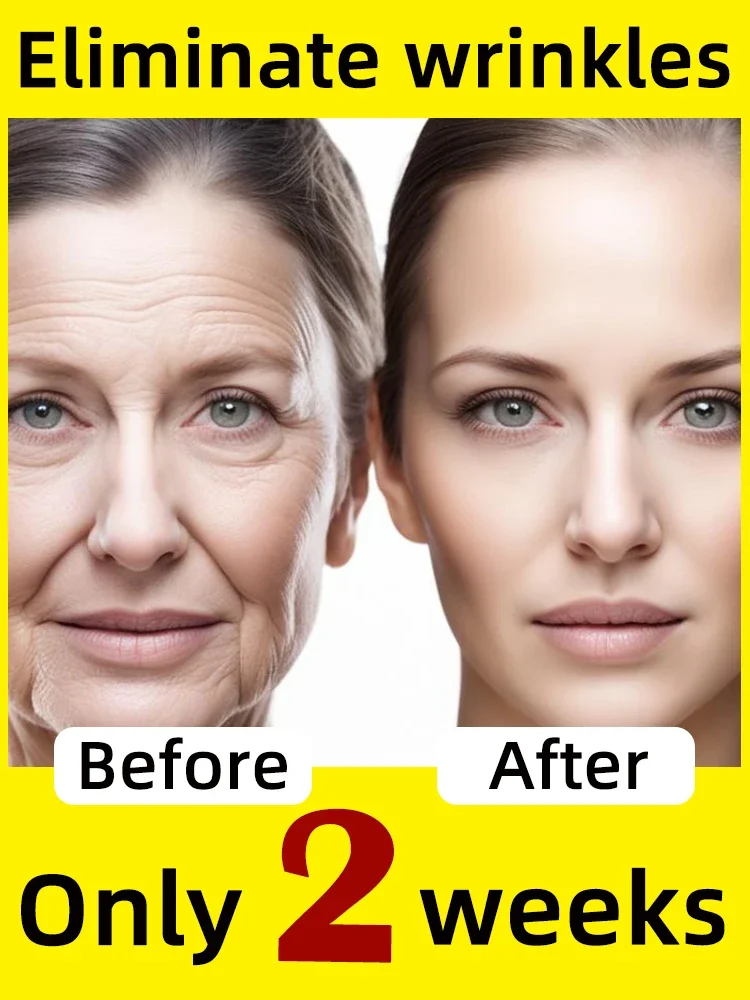 

Remove Frown Neck Lines