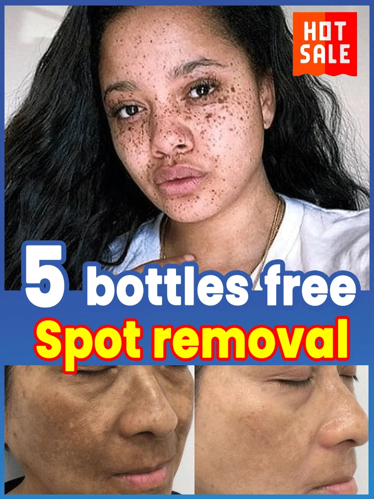 

Remove freckles and whiten the skin, lighten and brighten facial dark spots