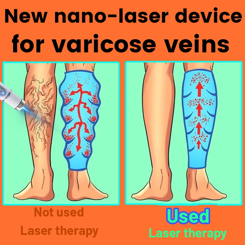 

Specially designed for varicose veins, ten years of research and development, just to solve varicose veins.
