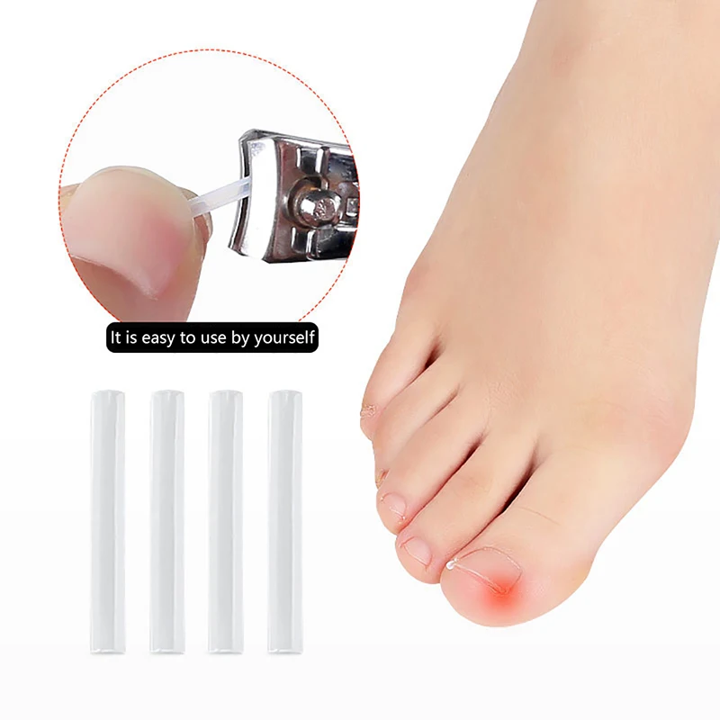 10/20/30/50Pcs Ingrown Toenail Correction Stickers Filling Pad Nail Corrector Patches Paronychia Treatment Recover Pedicure Tool