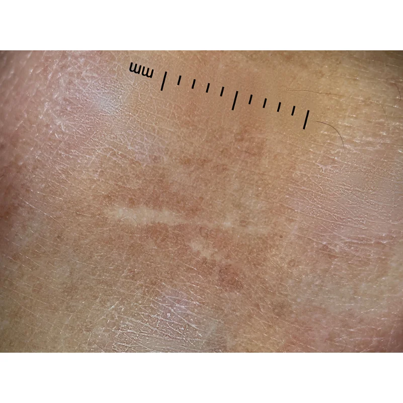 IBOOLO DE-300ใช้ Polarized Dermestid สำหรับ Dermatology