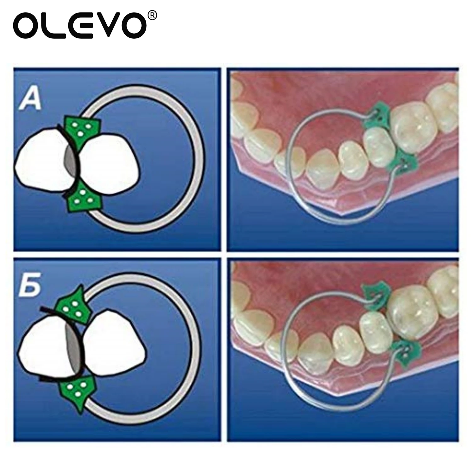 40 sztuk/worek silikonowych wkładek klinów gumowych klinów dentystycznych z pierścieniem Delta wyprofilowany materiał do renowacji dentysty nr 1.861