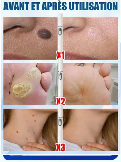 blauw licht pen los wratten op, hete verkoop wrattenverzorgingstools