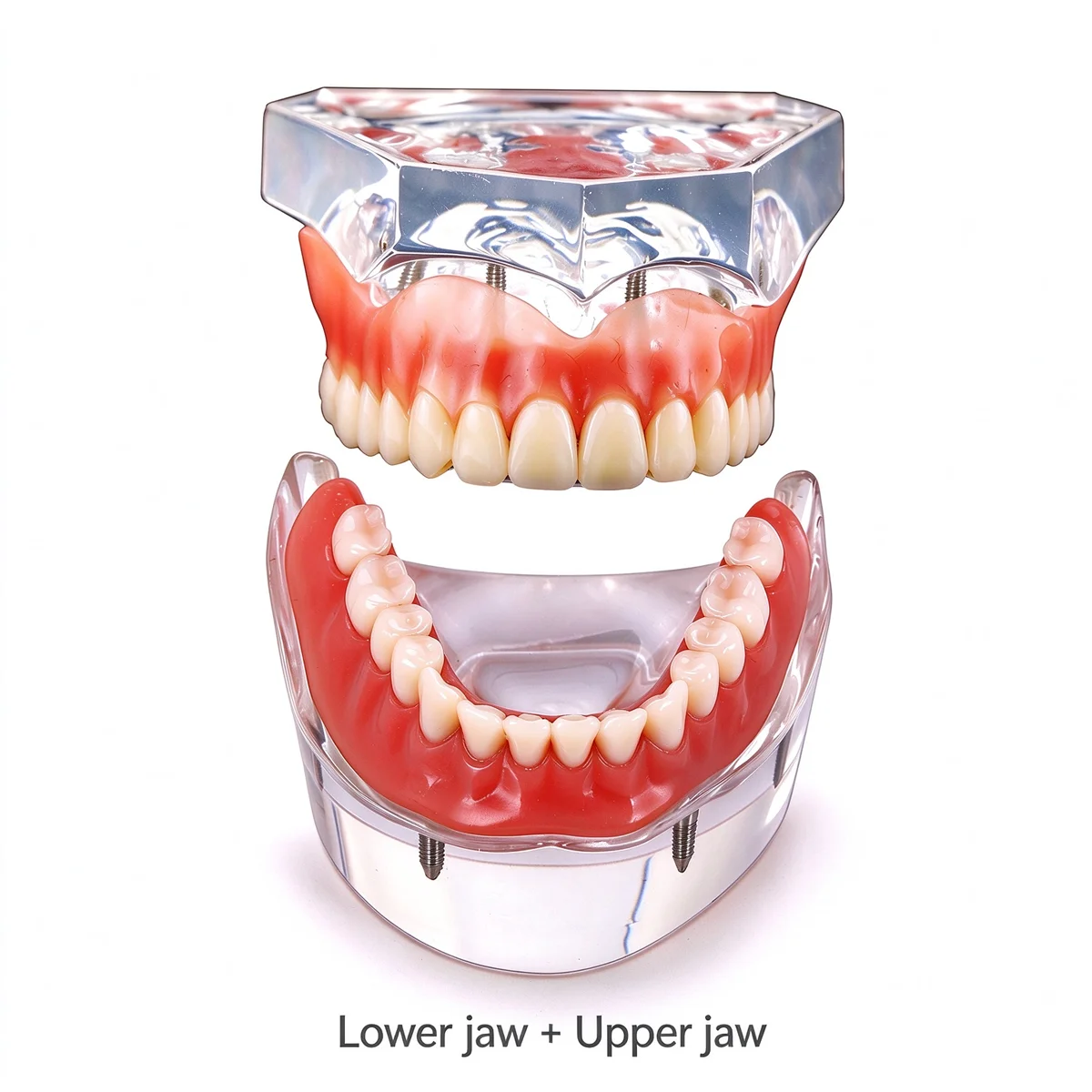 Dental Implant Teeth Models Dentistry Overdenture Model With 4 Implants Upper/Lower Jaw Model For Dentist Demo Teaching Study