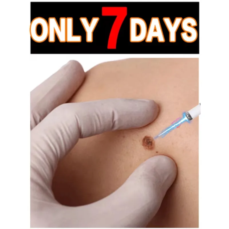 Blue Light Pen Quickly Removes Warts, a Best-Selling Wart Care Tool