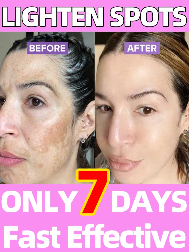 

Sun Dark Age Spot Freckles Chloasma