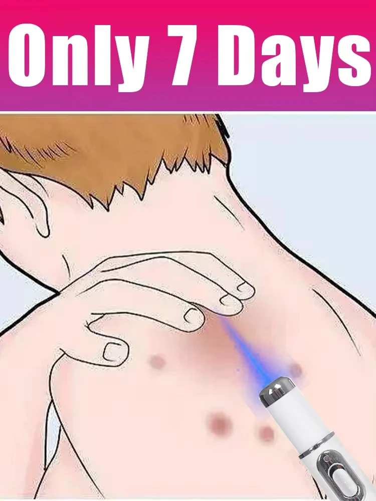 

Новейший лазерный прибор для удаления бородавок, популярный инструмент для ухода с синим светом