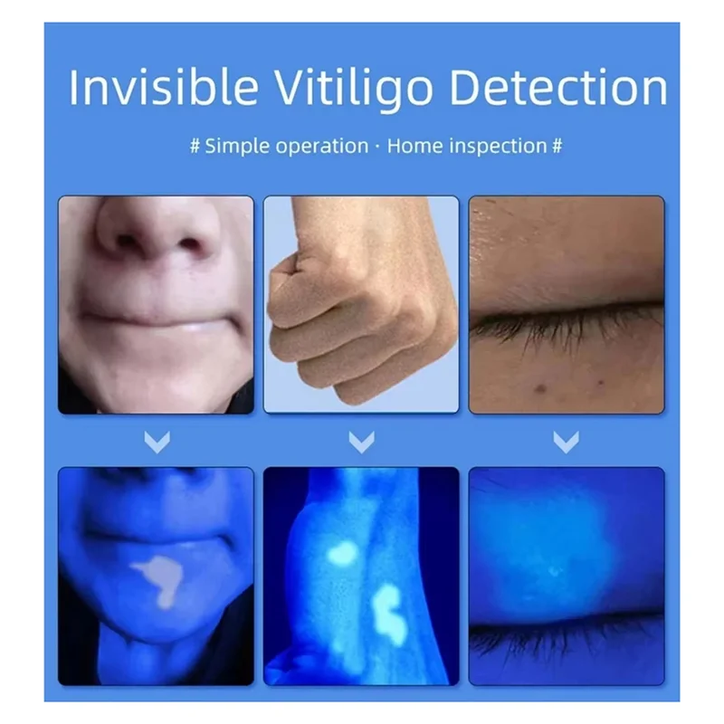 TCF-lampe d'analyse de peau pour la peau loupe UV pour la beauté test du visage lampe en bois détection d'analyse de la peau légère