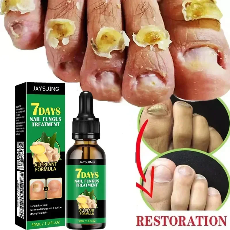 Essence liquide réparatrice des ongles, soin des mains, élimination des champignons des pieds, sérum réparateur, anti-infectieux, paronyamitié, vernis à ongles, produits de réparation