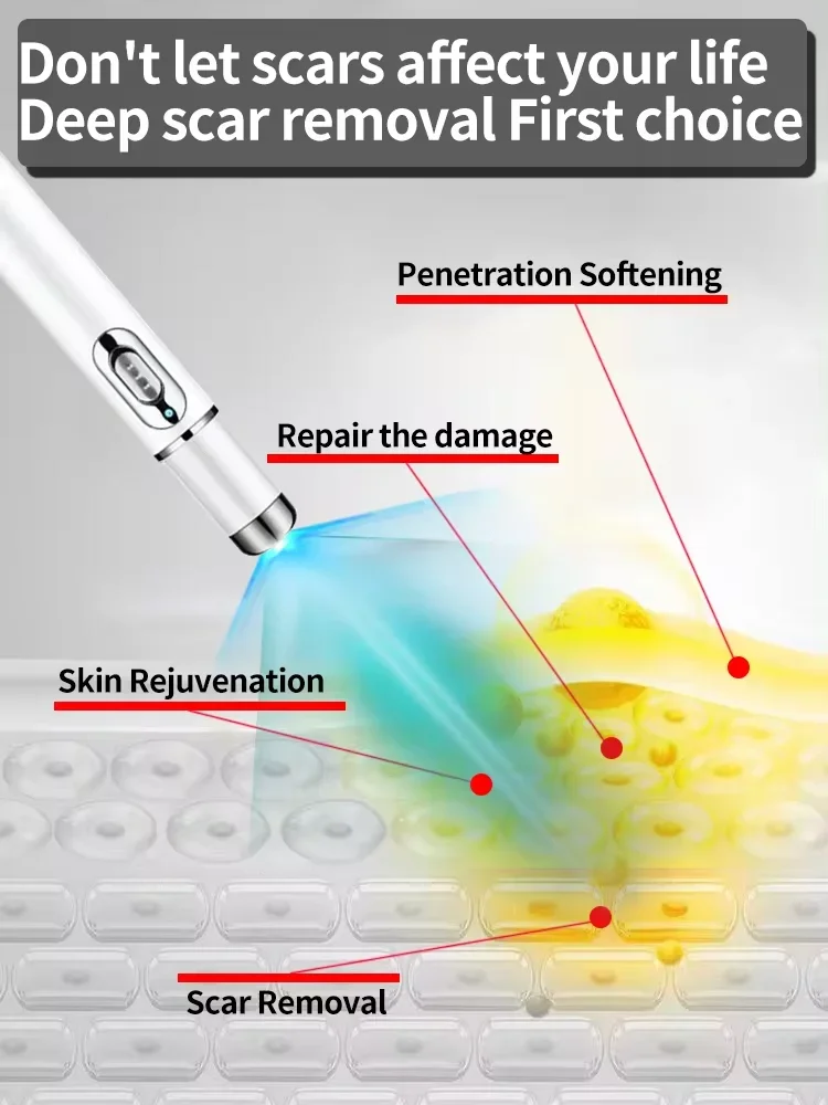 Réparation au laser très efficace, chéloïdes