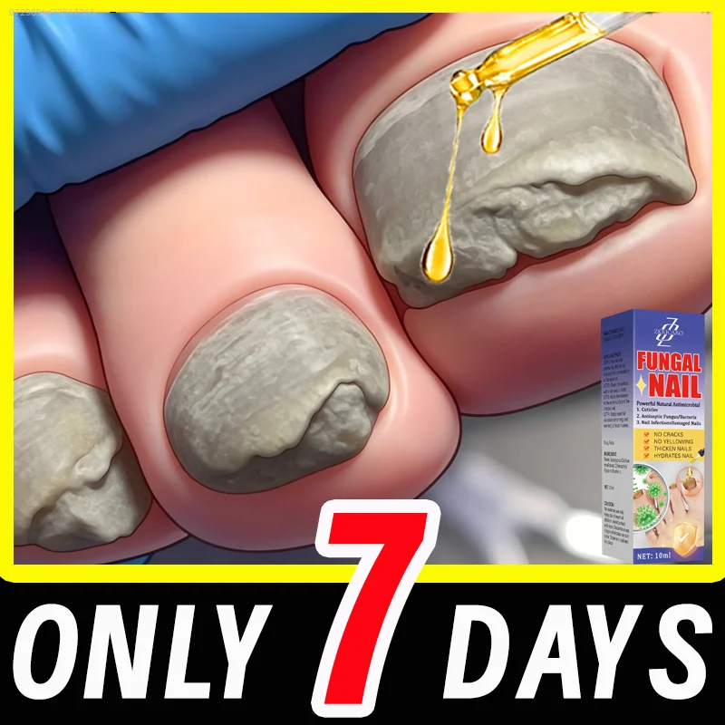 

Gentle ᴏɴʏᴄʜᴏᴍʏᴄᴏsɪs repair, restoring healthy and shiny ɴᴀɪʟs