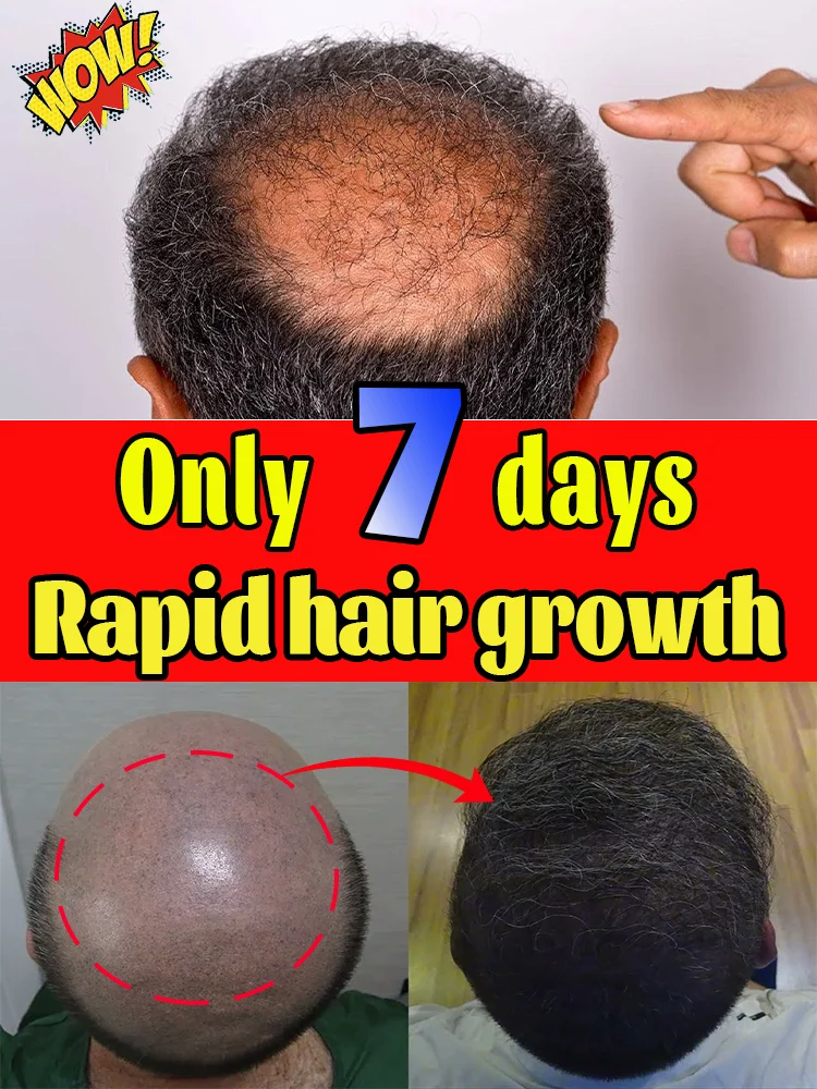 Sem desconforto, ss, taxa de redução de gordura 100% Sem desconforto, 