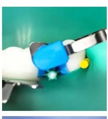 

40 Pcs Dental Adaptive Silicone Interdental Wedges Matrix for Medical Use Autoclavable Restorative and Composite Shaping Tools