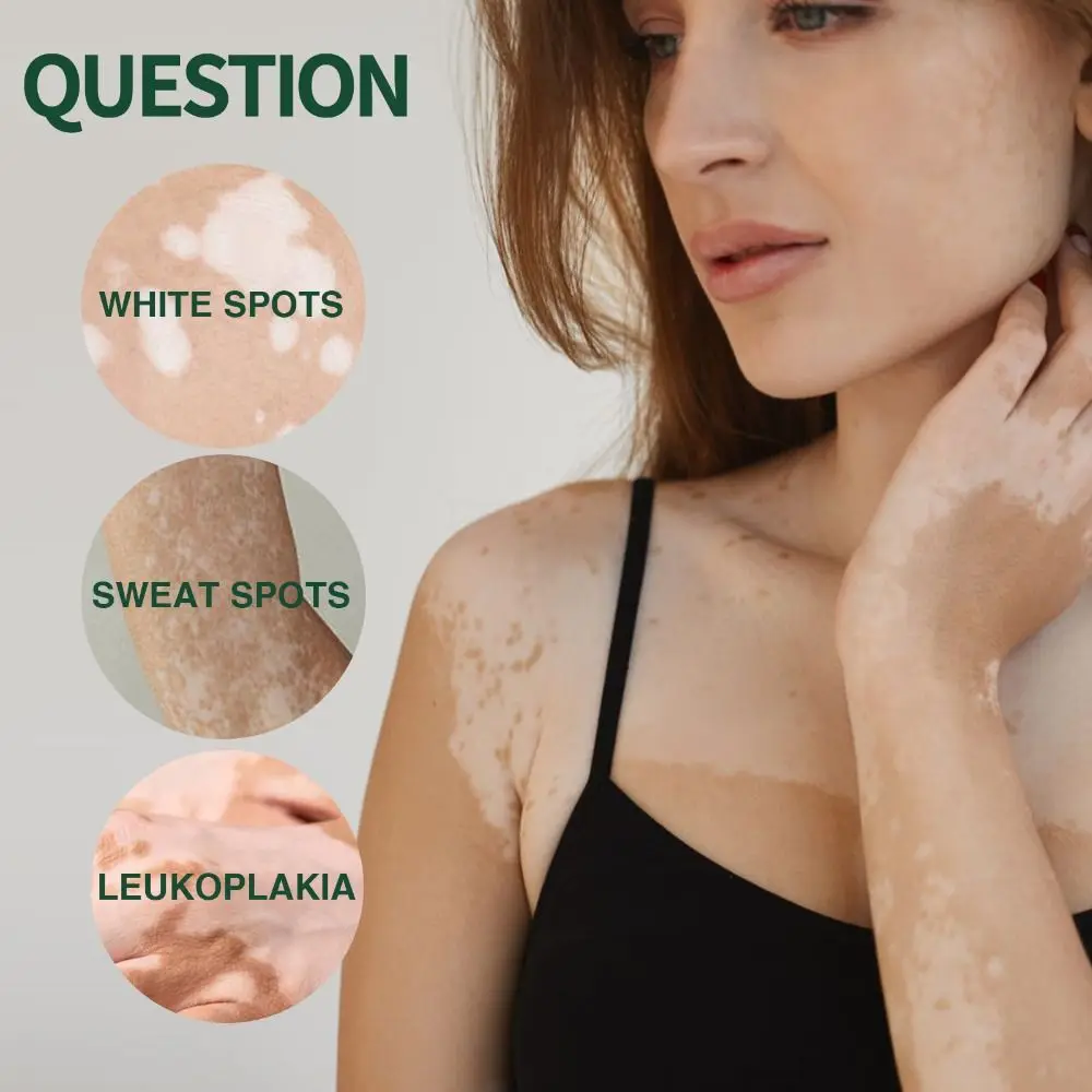 Natural TreatVitiligo Soothing Cream Improve Skin Discoloration Skin Care Vitiligo Care Cream Fast Soothing Moisturizes