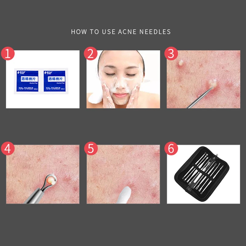 Aiguille d'élimination des points noirs du nez, outil de boutons noirs, extracteur de points blancs, outils de nettoyage du visage, nettoyeur de pores, pince à épiler, dissolvant d'acné