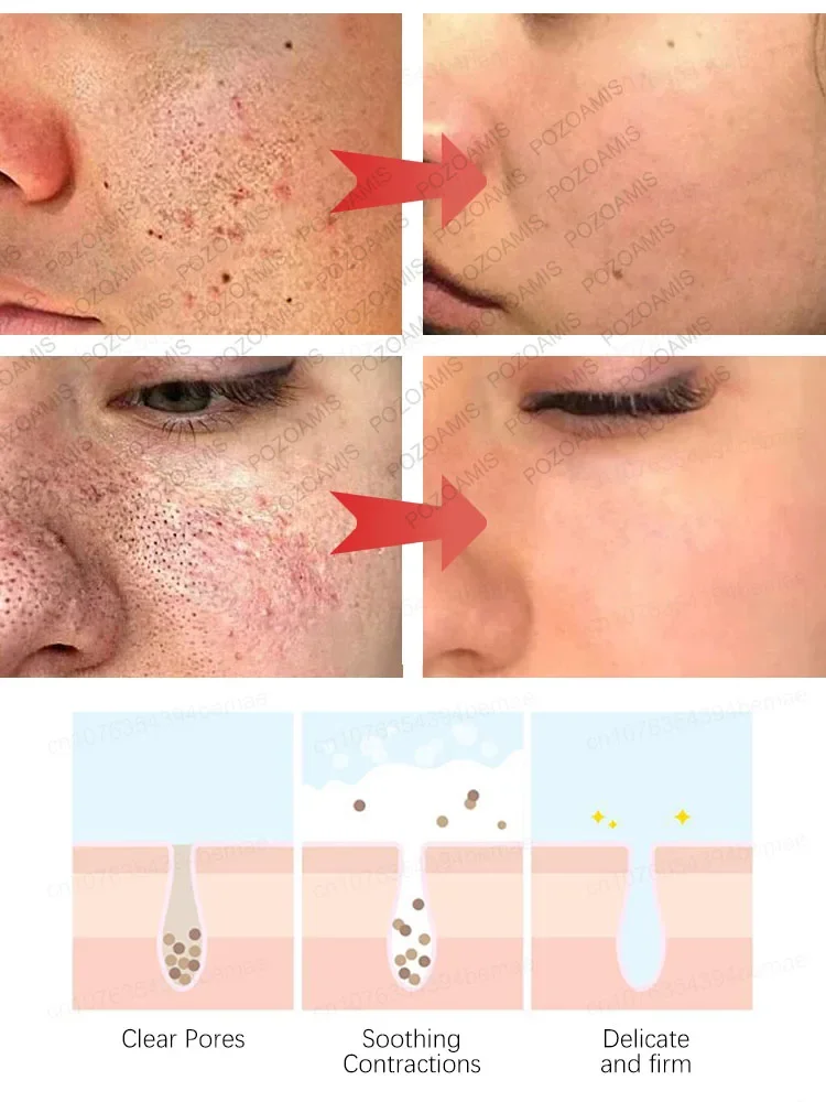 Get rid of large pores