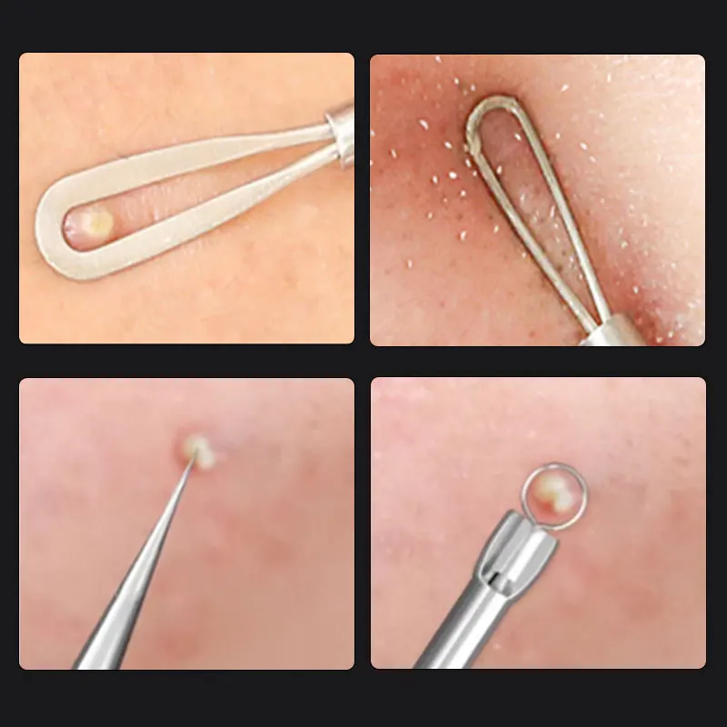 Stainless Steel Cellular Acne Blackhead Tweezers Facial Beauty Remove Acne Needle Tools for Blemish and Whitehead Skin Care Tool