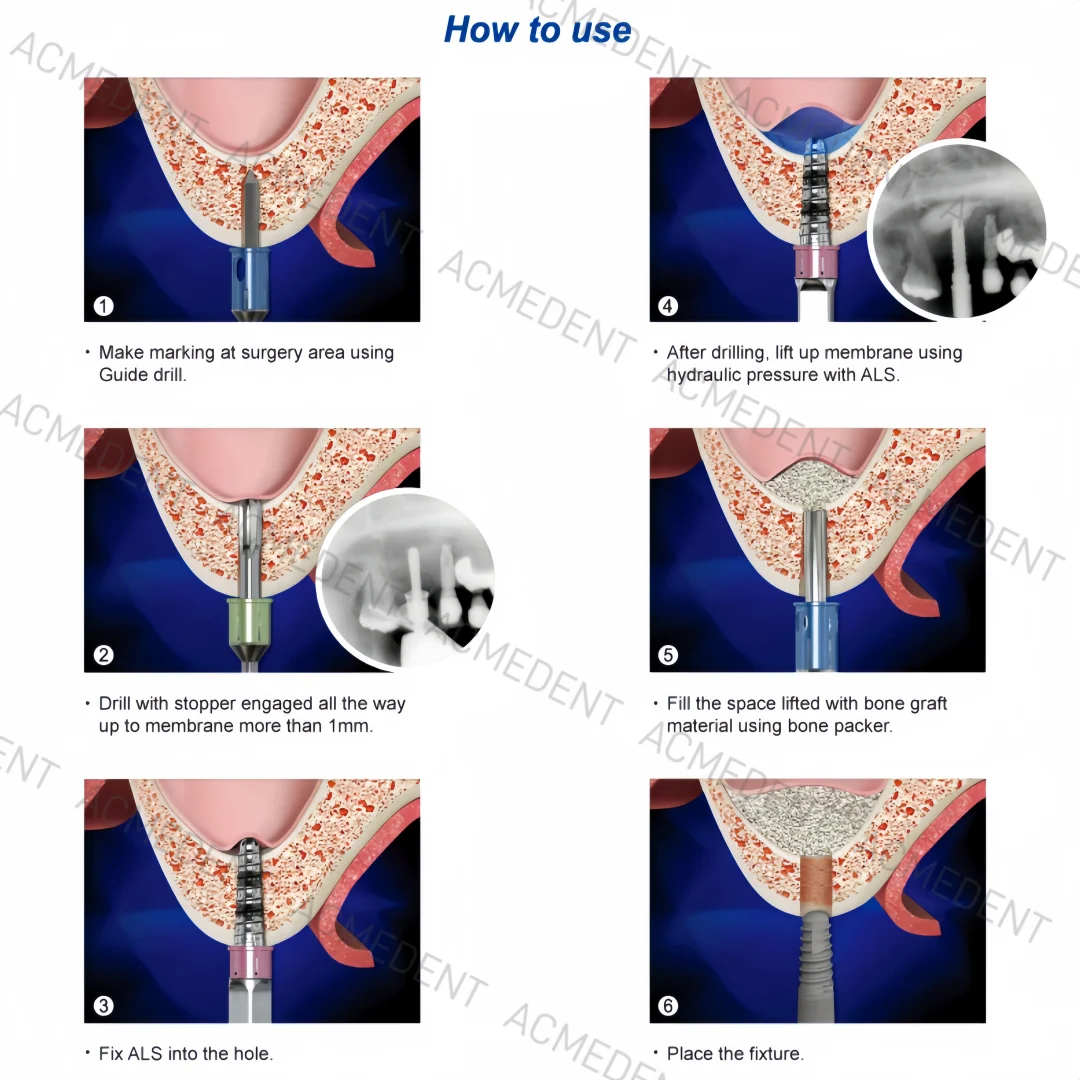 Membrana de elevación de seno maxilar Dental, elevador hidráulico de aumento de agua, tubo de agua con punta de agua, guía crestal CAS, implante de taladro quirúrgico