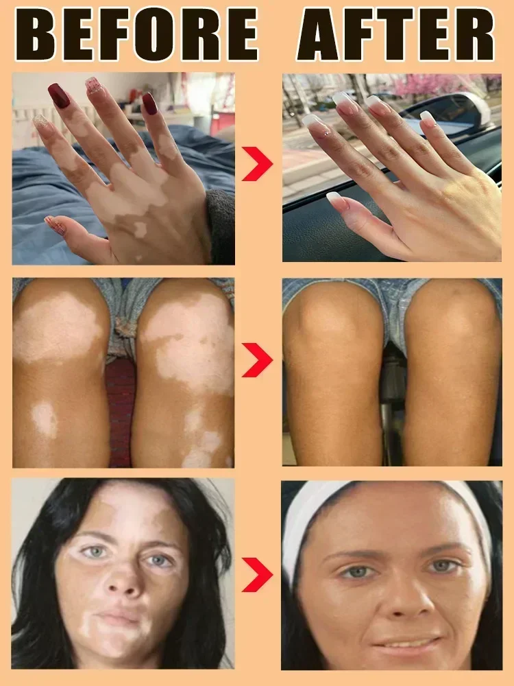 Vitiligo Ointment cream Ringworm Effectively Remove White Spot Removal Skin Vitiligo Eliminate Vitiligo Skin Care