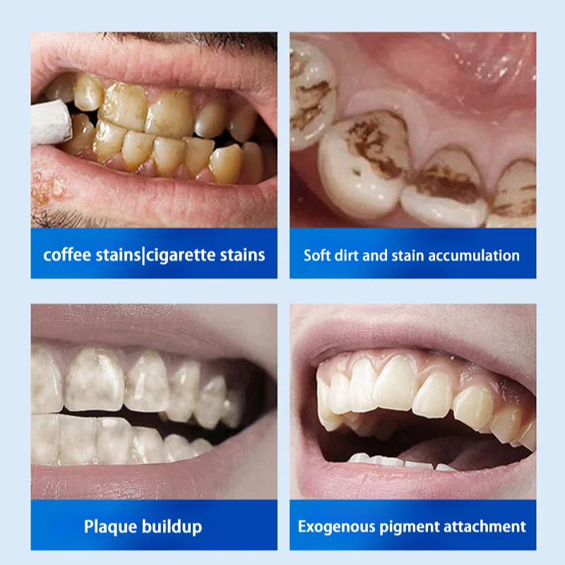 معجون تبييض الأسنان ، حساب إزالة الأسنان ، إزالة رائحة الفم ، رائحة الفم الكريهة ، منع التهاب اللثة ، معجون أسنان بالفلوريد