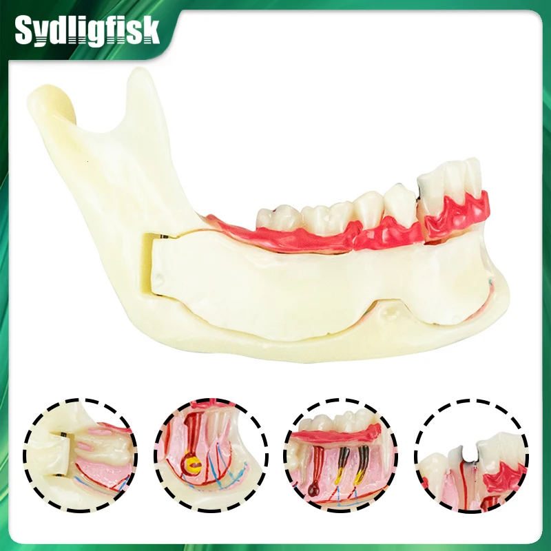 

Dental Endodontic Treatment Model Anatomy of Gums Mandible Tissue Anatomical Model Dentistry Study Oral Care Teach Teeth Model