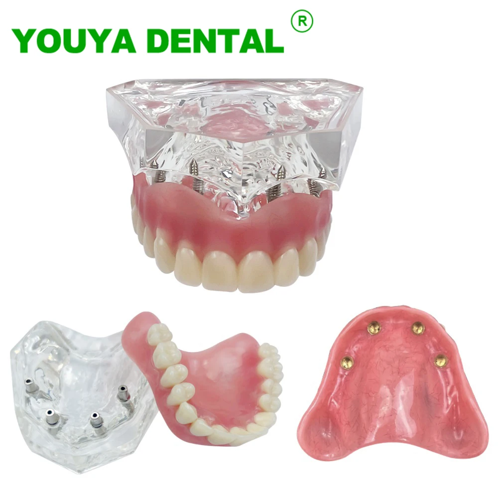 Dental Teeth Model Dentistry Upper Jaw M6001 Overdenture Model With 4 Implants For Student Dentist Patient Communication Models