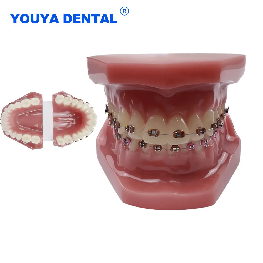 

Orthodontic Treatment Model with Full Ortho Metal Wire with Buccal Tube Ligature Ties Standard Model Dentistry Communication