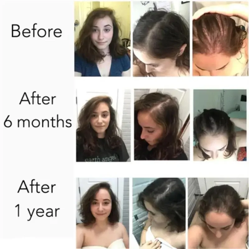 

Сыворотка для быстрого роста волос, эфирное масло для роста волос, против выпадения волос, восстановление поврежденной кожи головы, для женщин и мужчин, против облысения, уход за ростом волос