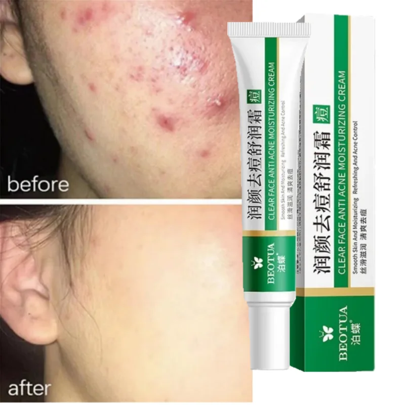 Salicylic Acid Pores Shrink Refining Cream Treatments Large Open Pore Remove Black Dots Blackhead Acne Marks Face Skin Products