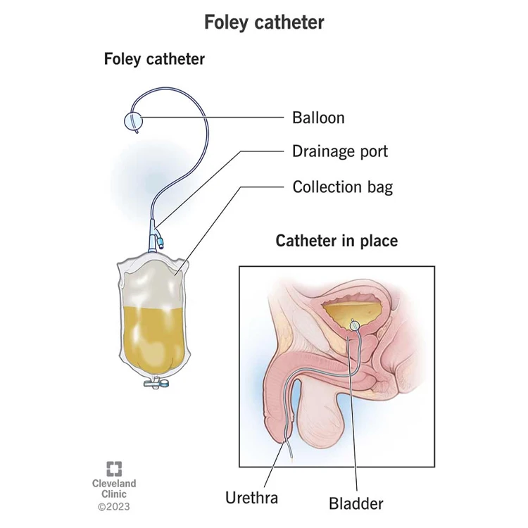 يمكن التخلص منها 10 مل سيليكون Fr18 قسطرة فولي حجم 16 قسطرة بالون الإحليل فائقة التشحيم مع اتجاهين