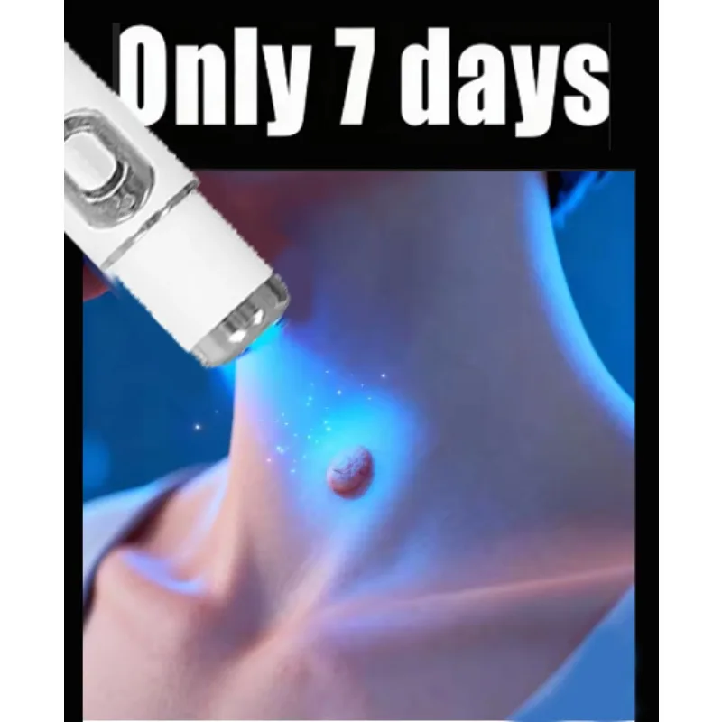 

Blue Light Laser Pen Make Warts Disappear And Skin Become Smooth Hot Sale In 2026