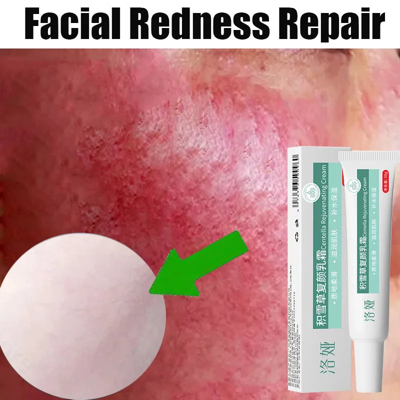 Instant Facial Redness Repair Cream Soothing Red Blood Rosacea Treatment Improve Sensitive Skin Anti Redness Skin Care Cosmetics