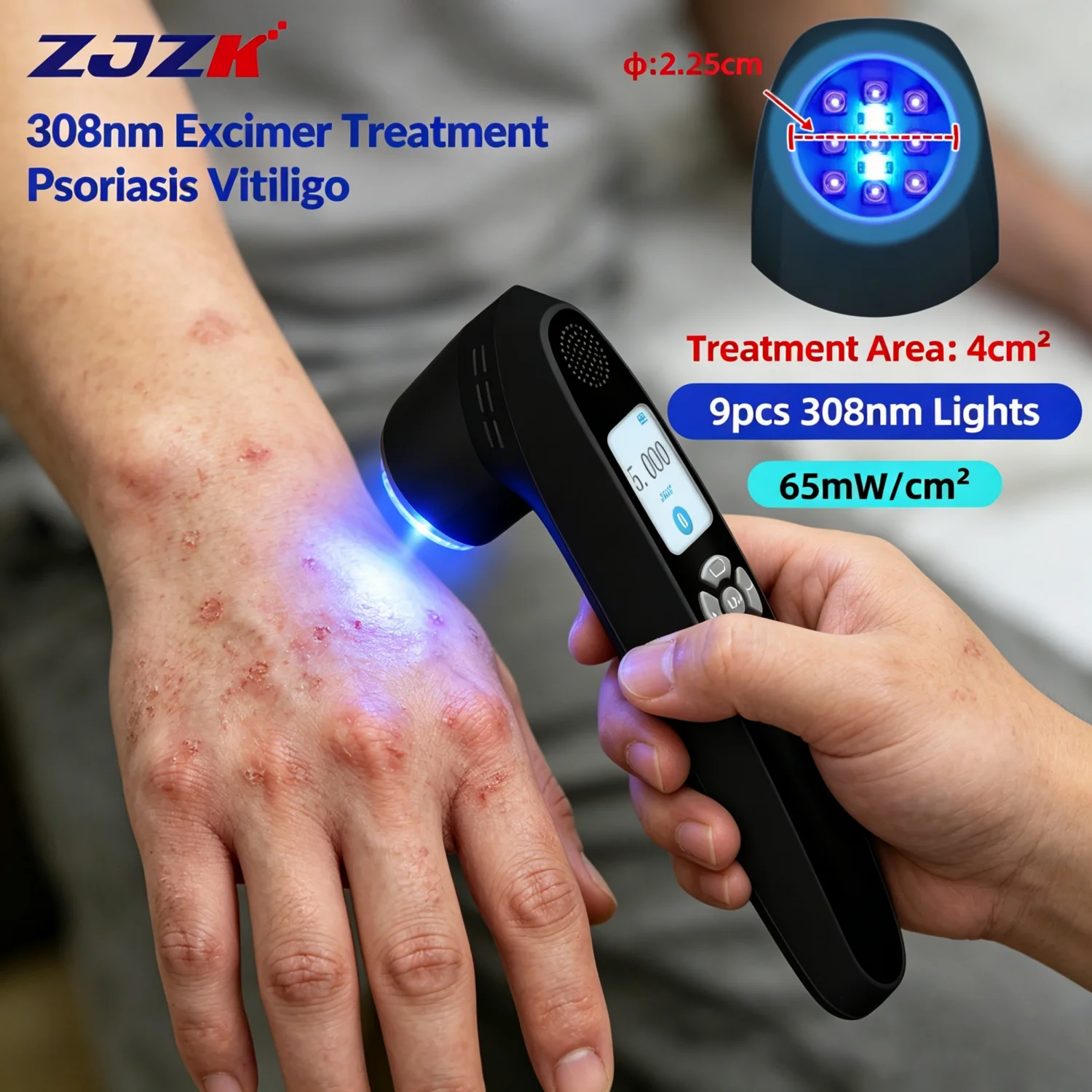 

2026 Medical 308 nm Excimer Uvb Light Vitiligo Laser Psoriasis Eczema Tratamiento Treatment Improvements in Skin Conditions