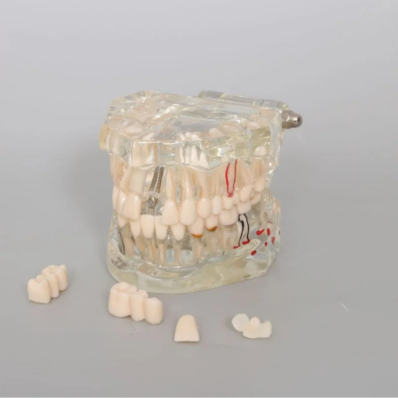 High quality transparent dentistry Oral transparent restoration dental implant model