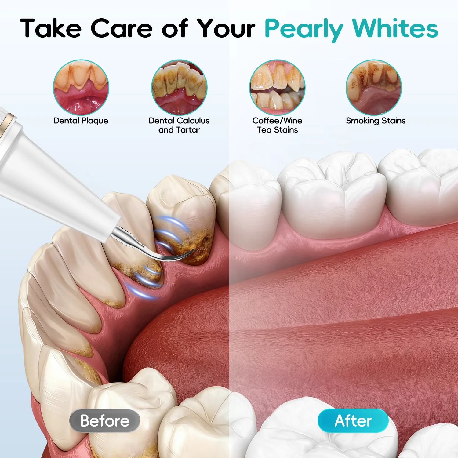 مزيل البلاك/الترار للأسنان، مجموعة تنظيف مزيل حساب التفاضل والتكامل للأسنان مع ضوء LED - 4 رؤوس وحقيبة شحن معقمة بالأشعة فوق البنفسجية #3