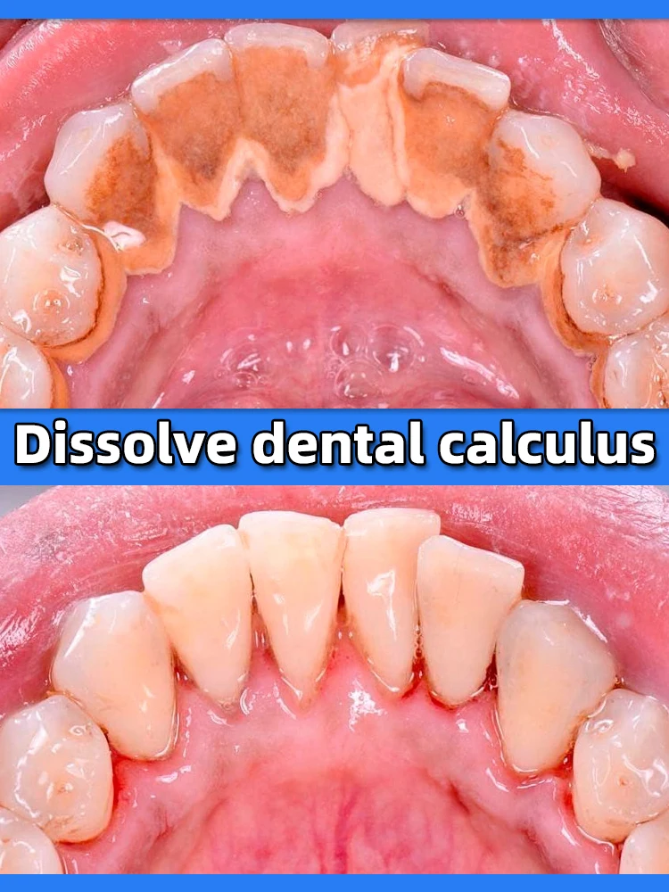 Dentífrico removedor de cálculo dental, remover os dentes amarelos, mau hálito, placa de limpeza, mancha dentária, clareamento, prevenção da periodontite